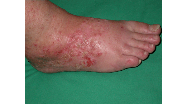 https://www.therapeutique-dermatologique.org/IMG/gif/85-Figure-2b.gif