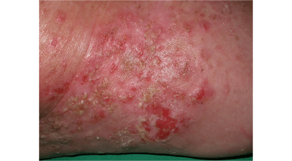 https://www.therapeutique-dermatologique.org/IMG/gif/85-Figure-3b.gif