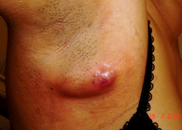 https://www.therapeutique-dermatologique.org/local/cache-vignettes/L600xH429/2832_FIG-1-89130.gif